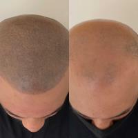 Ultimate Scalp SMP Leicester image 19